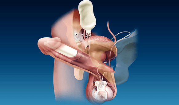 riempitivi a spessore di silicone e gel